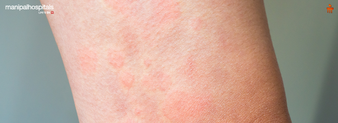 बुरशीजन्य संसर्गाची लक्षणे