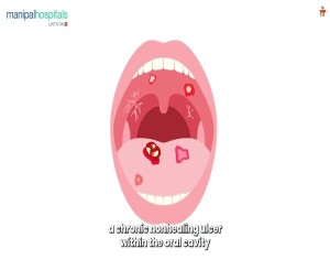 Oral Cancer | Dr. Pavan Prasad B. K. | Manipal Hospital Jayanagar