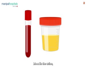 Prostate Cancer | Dr. Pavan Prasad B. K. | Manipal Hospital Jayanagar