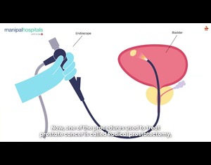Managing Prostate Surgery Side Effects