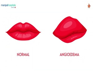 Understanding Angioedema