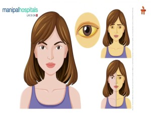 Pancreaticoduodenectomy Explained | Dr. K Hemanth Kumar | Manipal Hospital Old Airport Road