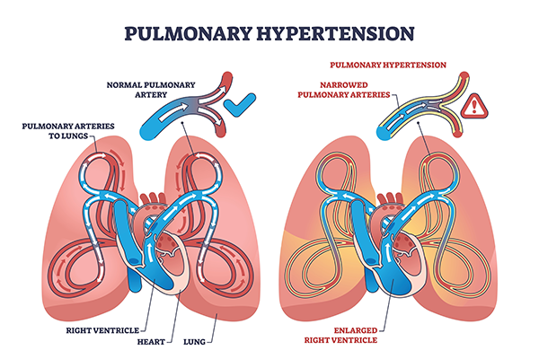 Pulmonary Hypertension Symptoms