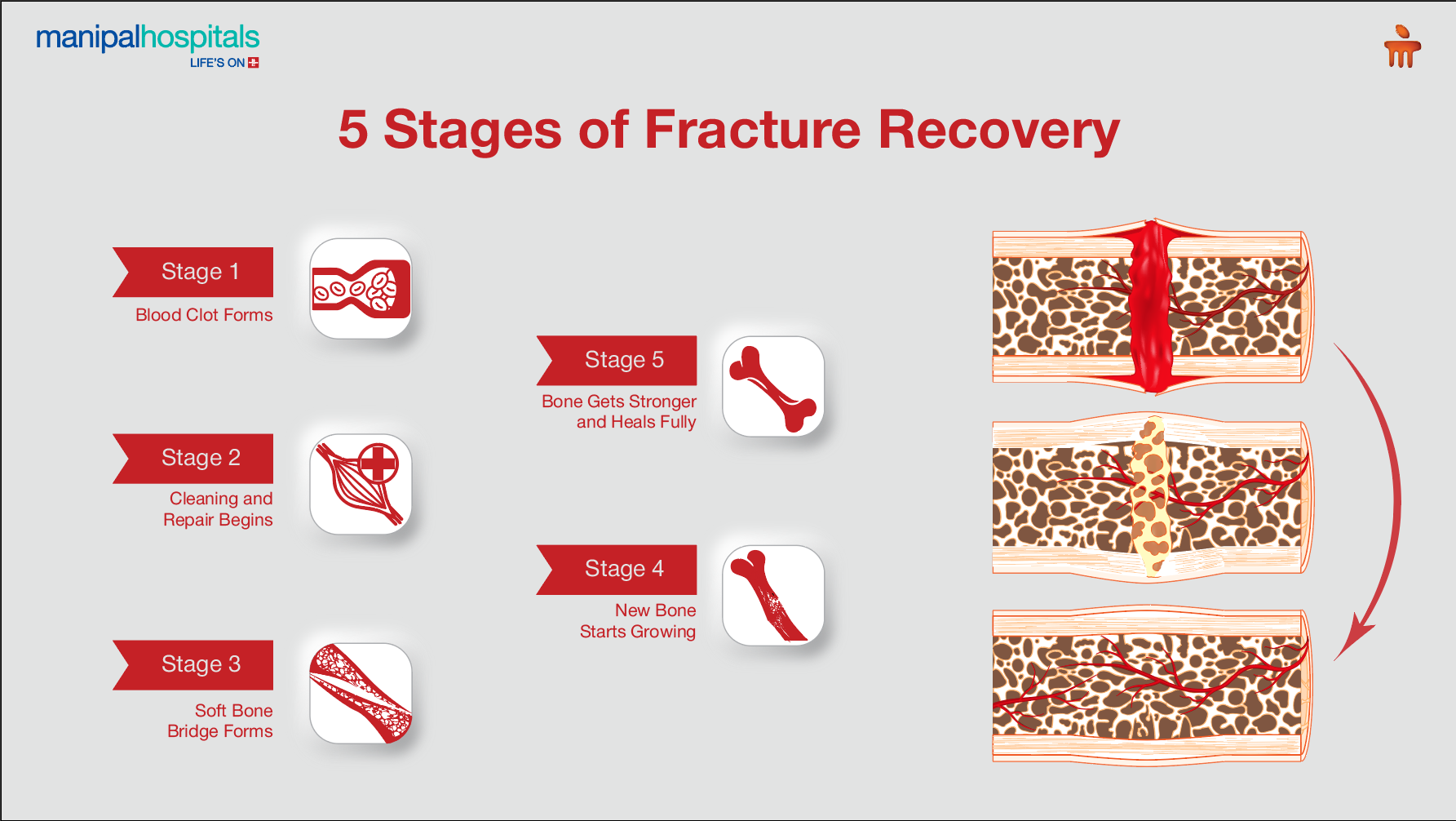 5 stages of fracture healing