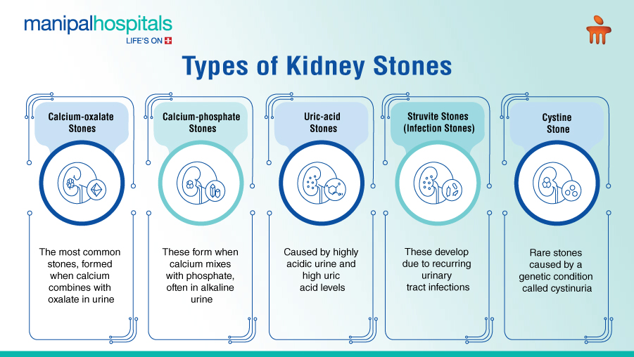 Kidney Stones: 5 Types, Causes and Prevention Diet