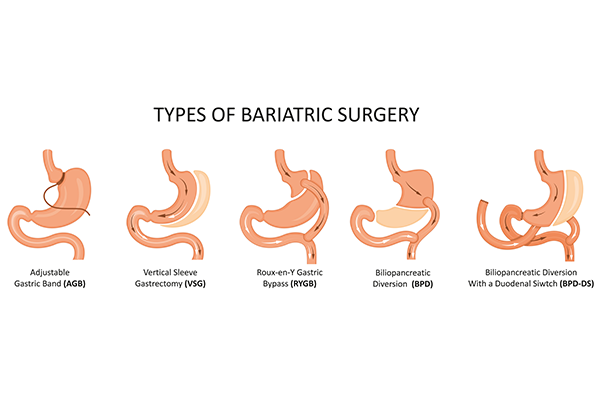 7-Day Diet Plan After Bariatric Surgery