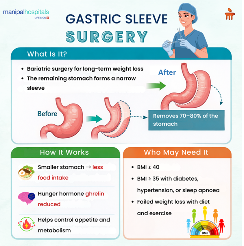 A Complete Guide to Gastric Sleeve Surgery for Weight Loss
