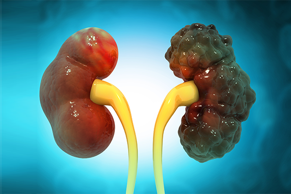 Acute vs Chronic Kidney Disease: Key Differences Explained