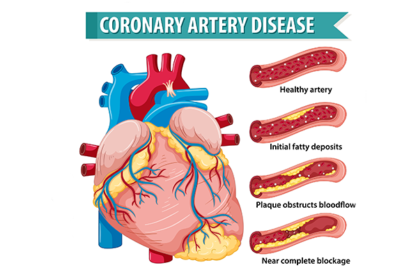 Angiography: A Life-Saving Test for Early Detection of Coronary Artery Disease