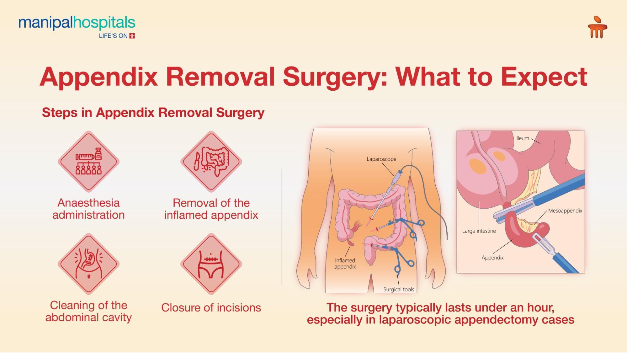 Appendicitis treatment
