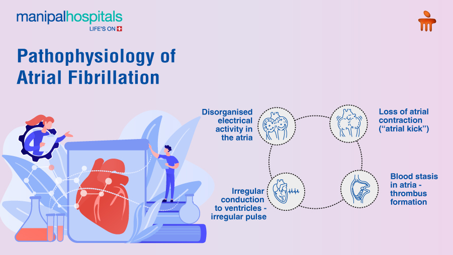 Atrial Fibrillation (AFib): Silent Irregular Heartbeat That Increases Stroke Risk