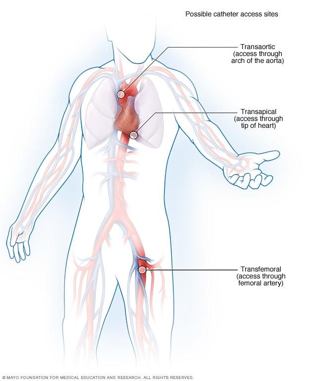 Minimally invasive cardiac procedures