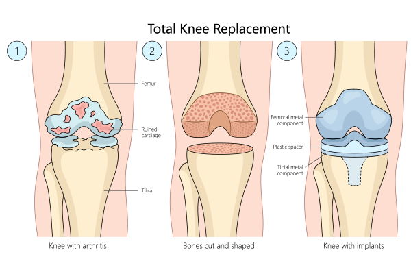 Benefits of Total Knee Replacement