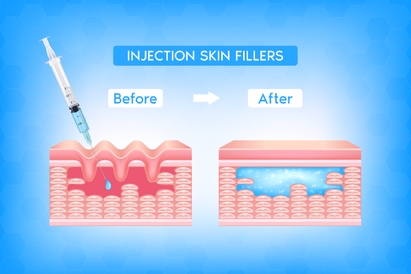 Botox Treatment