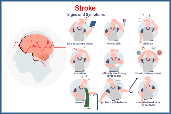 What is Brain Stroke? Types, Symptoms and Treatment