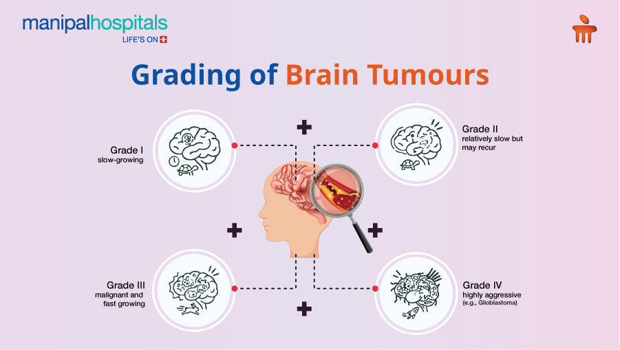 Brain tumour symptoms people often ignore