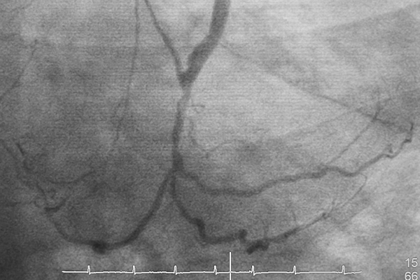 CABG vs Angioplasty: Understanding Differences, When to Choose, and Recovery