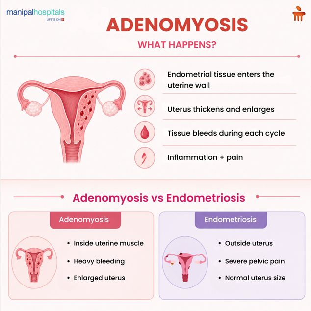 Can Adenomyosis Be Cured? Symptoms, Treatment & Diet Guide