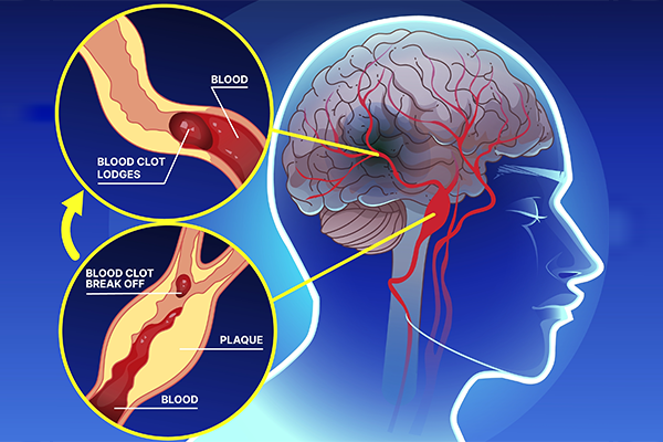 coma-after-brain-aneurysm-symptoms-diagnosis-treatment