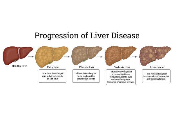 Liver Disease: Types, Stages & Medical Management