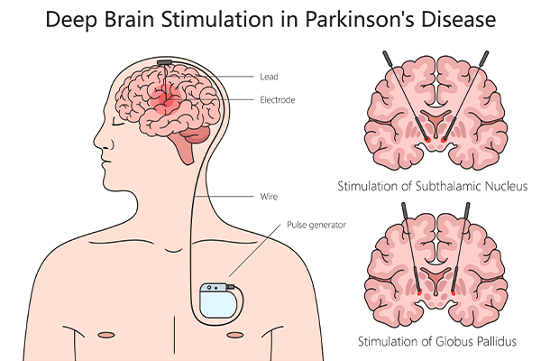 Deep Brain Stimulation for Parkinson's Disease Control