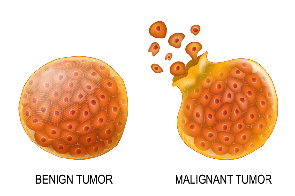 Difference between Benign and Malignant Brain Tumors