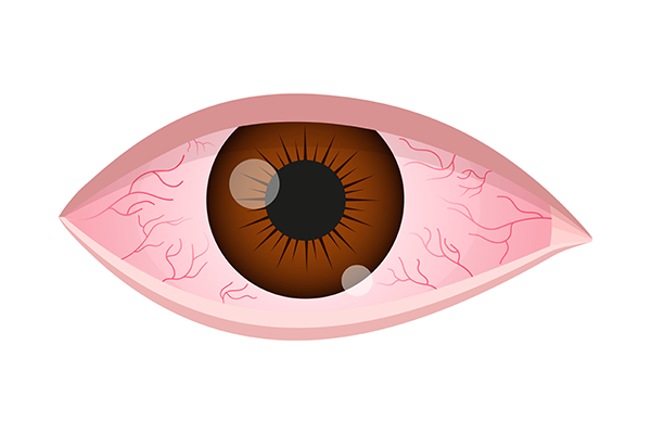 dry-eye-syndrome-home-remedies