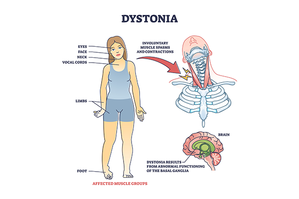dystonia symptoms