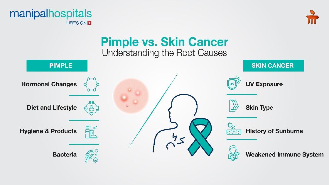 Skin Cancer vs Pimple