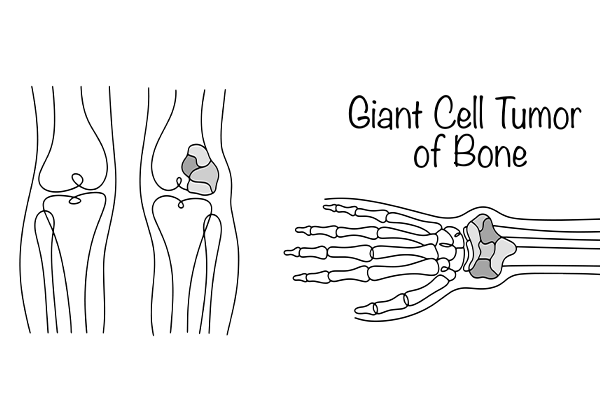 Giant cell tumour of bone