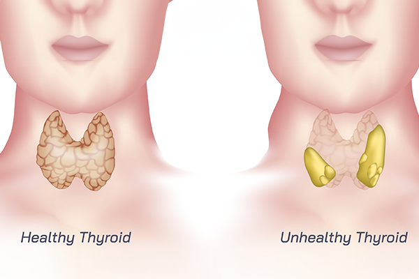 Goiter symptoms, causes, and treatment options