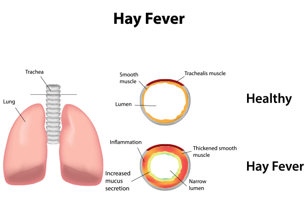 What is Allergic Rhinitis (Hay Fever)? Symptoms, Causes, and Treatment Tips