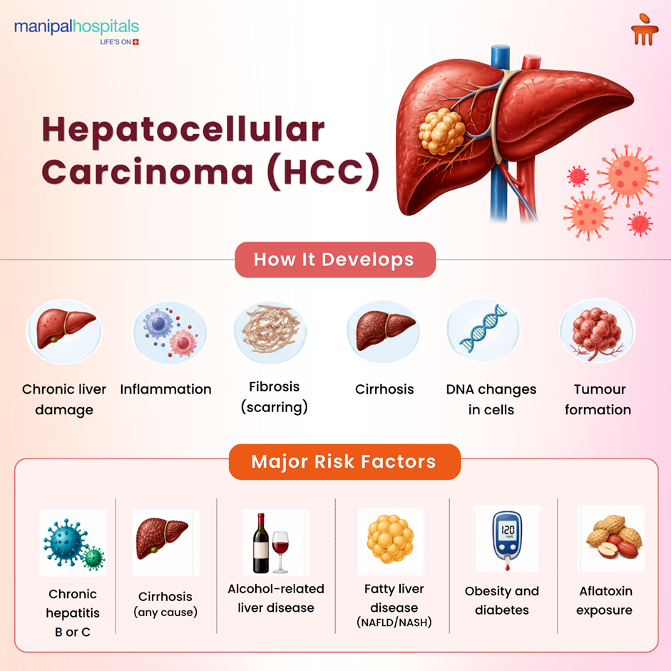 Hepatocellular Carcinoma HCC: Meaning, Symptoms & Treatment Options