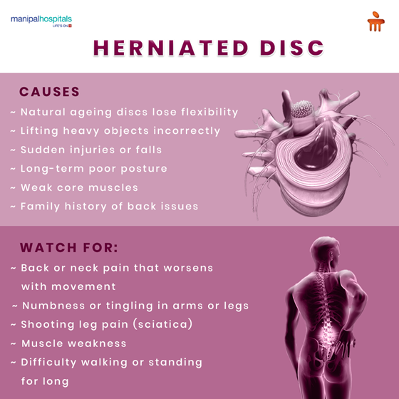 Herniated Disc: Symptoms, Causes, and Treatment Options