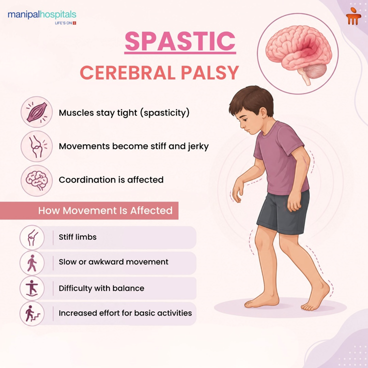 How Spastic Cerebral Palsy Affects Movement: Symptoms & Therapy Approaches