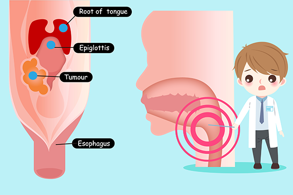 Oral Cavity Cancer