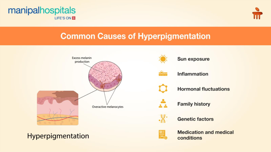 Hyperpigmentation: Causes, Treatment Options, and How to Prevent It 