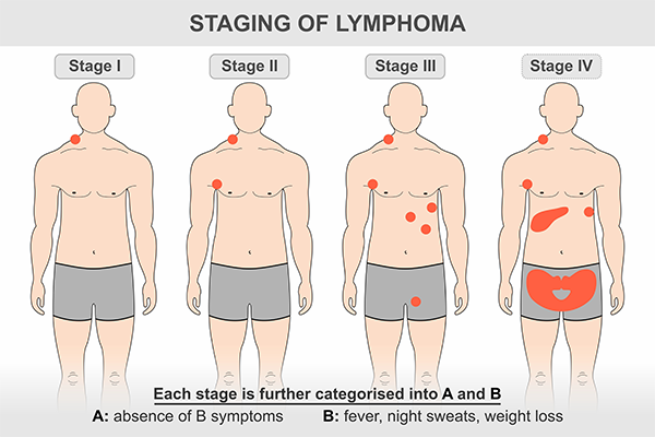 Lymphoma Symptoms, Causes, and Treatment