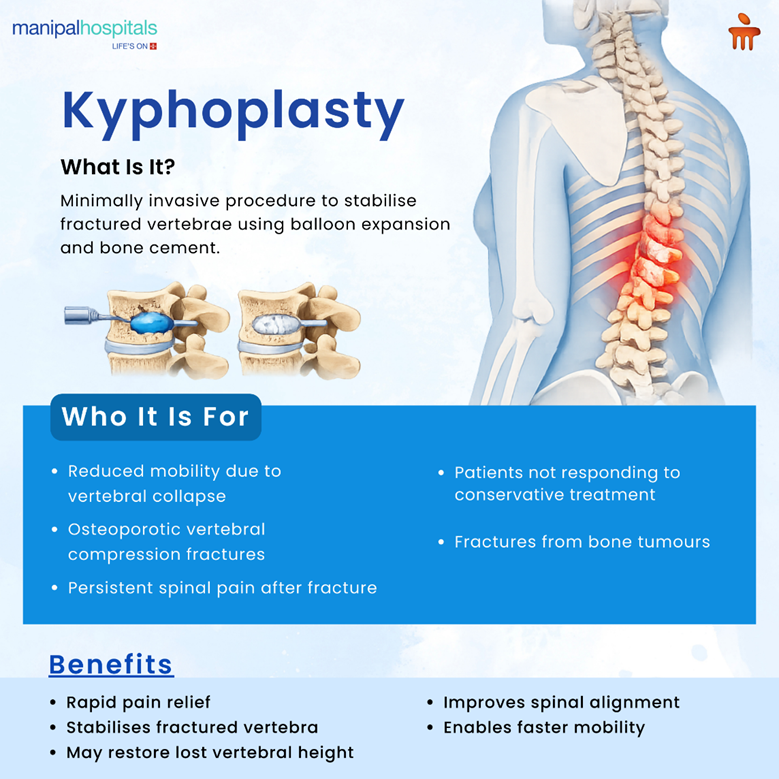 Kyphoplasty Explained: How the Procedure Restores Stability After Vertebral Fractures?