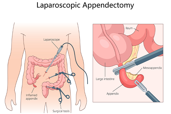 Laparoscopic Appendectomy