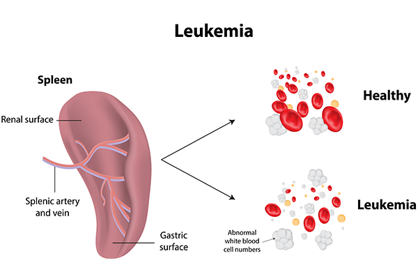 leukaemia-types-symptoms-treatment-guide