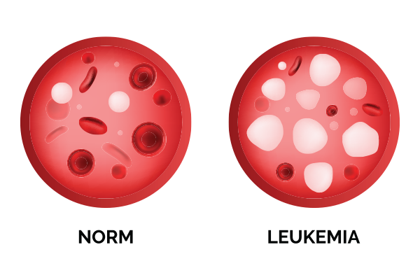leukeamia symptoms