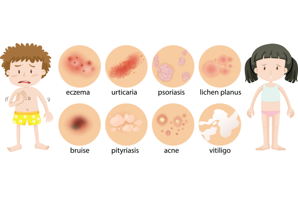 Managing Eczema in Children: Causes, Triggers, and Treatment Options