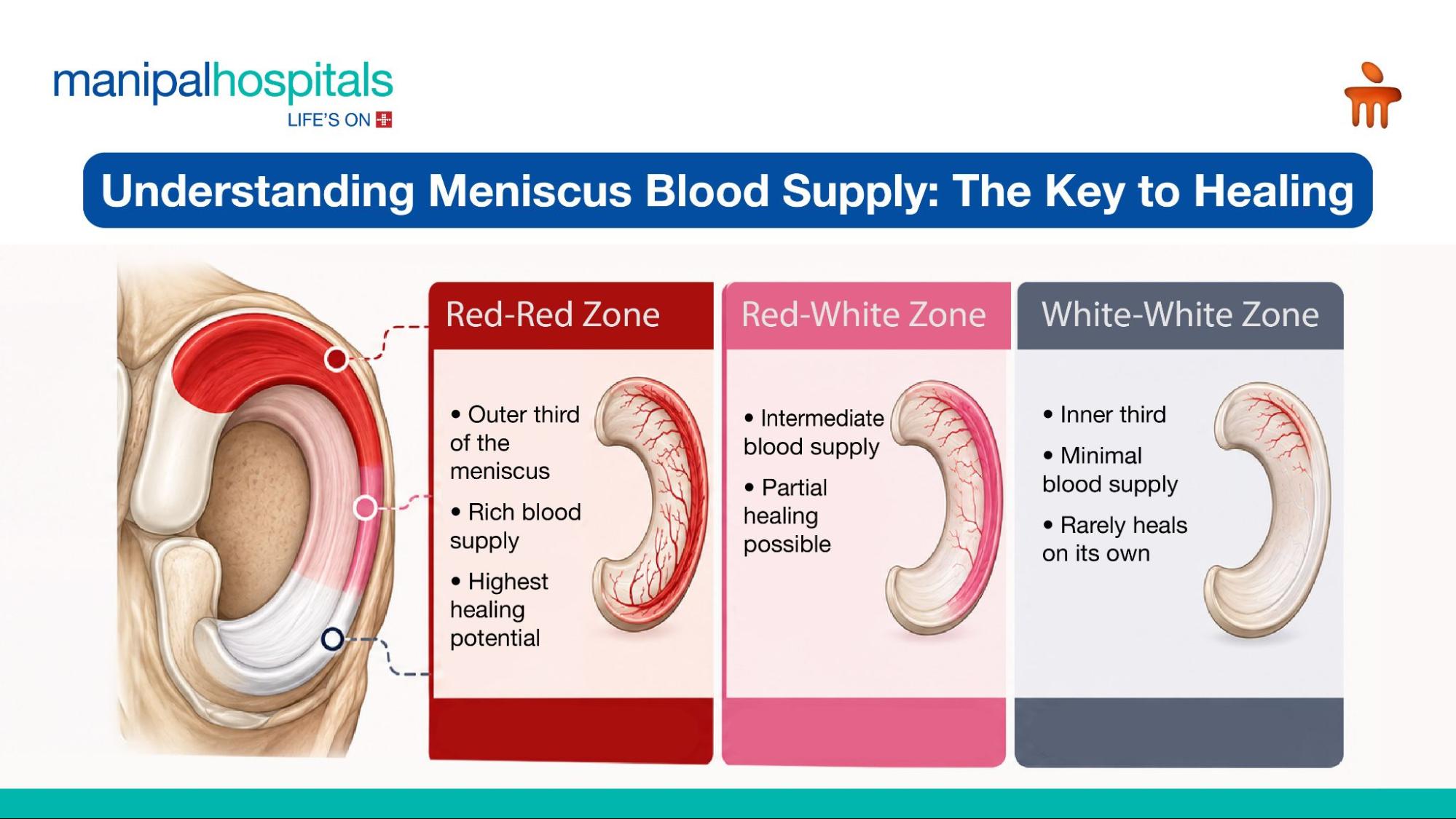 Meniscus Injury