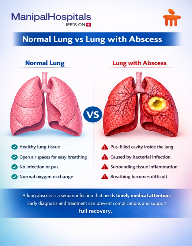 Lung Abscess: An Expert Guide to Symptoms, Diagnosis, and Treatment