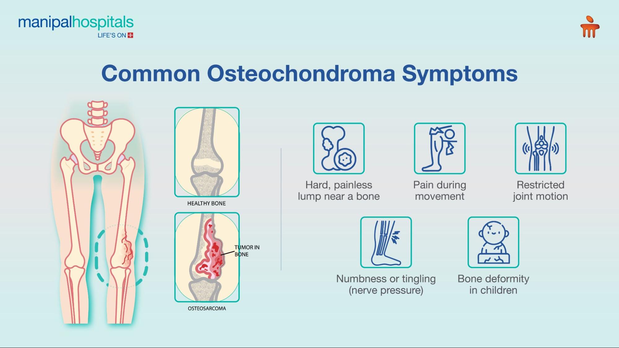 Osteochondroma early signs of common bone tumor
