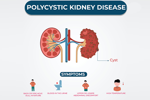 Polycystic Kidney Disease (PKD): What You Should Know