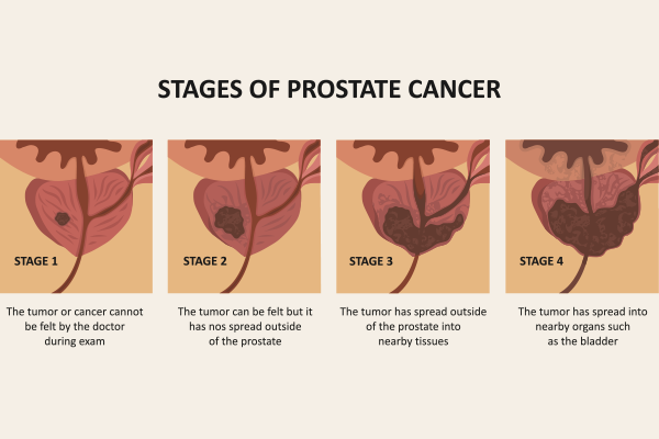 Prostate Cancer