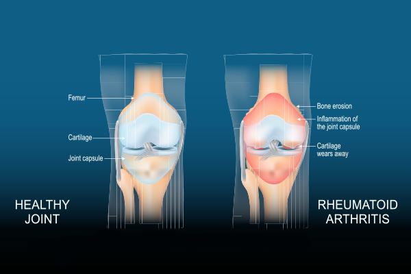 Rheumatoid Arthritis Treatments: Options for Managing Symptoms
