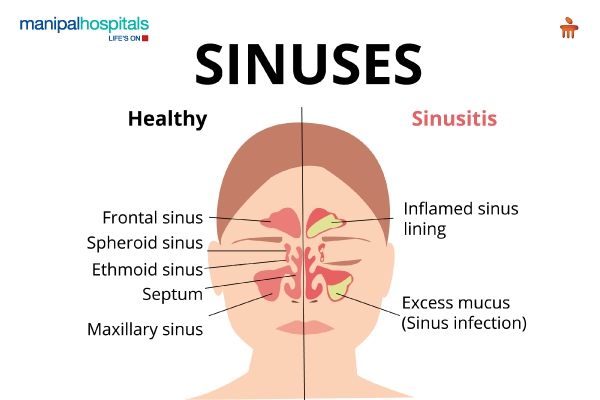 Sinus Headache home remedies